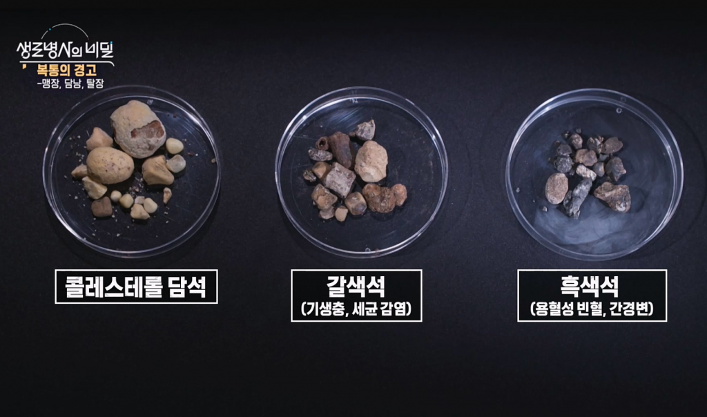 생로병사의비밀-993회